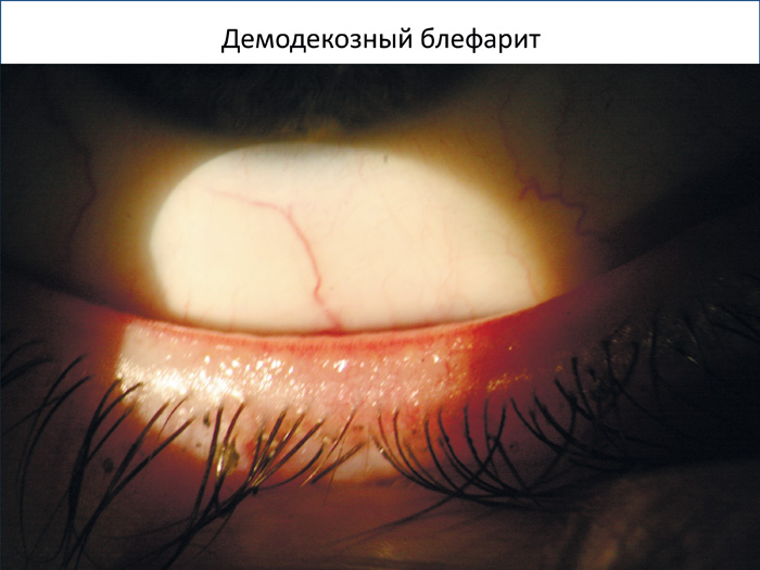 Фото блефарит у новорожденных